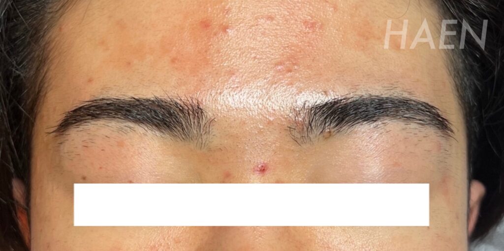 眉毛のデザインニードル脱毛(美容電気脱毛)施術前の様子