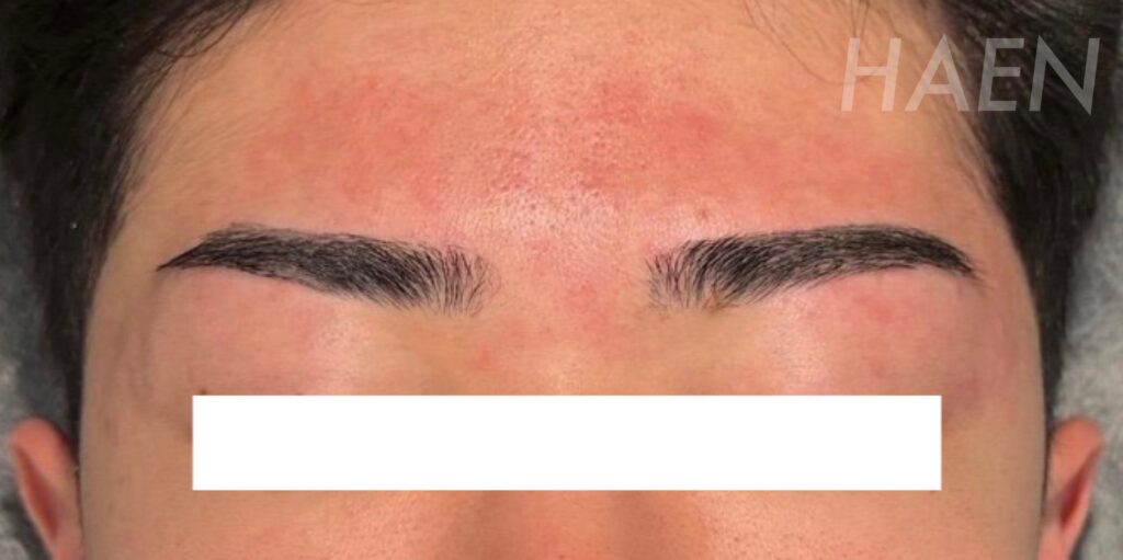 眉毛のデザインニードル脱毛(美容電気脱毛)施術10回後の様子