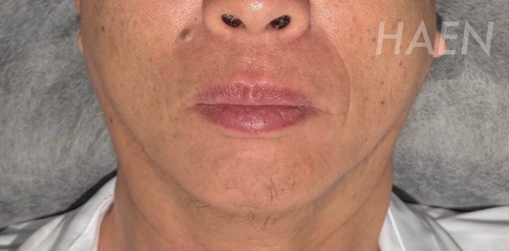 白髭のニードル脱毛(美容電気脱毛)10回施術後の様子