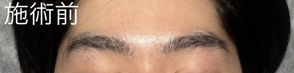 眉毛ニードル脱毛(針脱毛)施術前