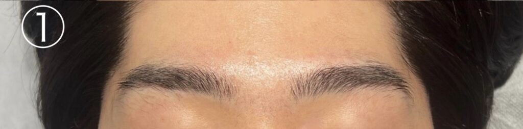 眉毛ニードル脱毛(針脱毛)1回目