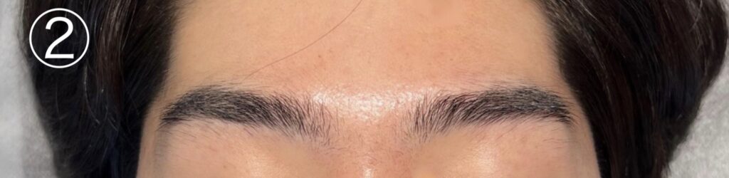 眉毛ニードル脱毛(針脱毛)2回目