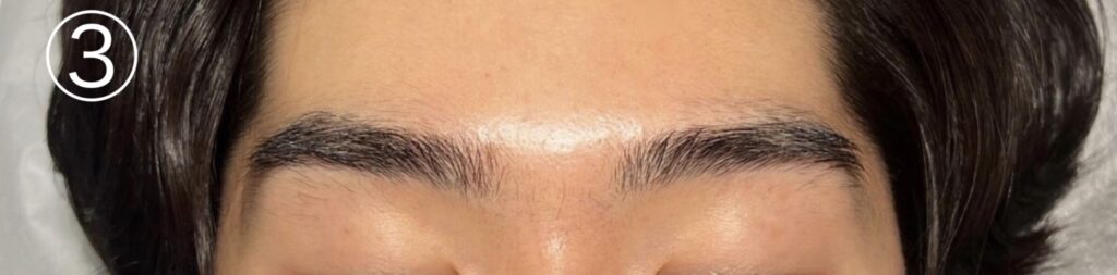 眉毛ニードル脱毛(針脱毛)3回目
