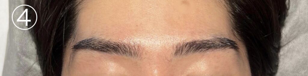 眉毛ニードル脱毛(針脱毛)4回目