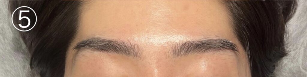 眉毛ニードル脱毛(針脱毛)5回目