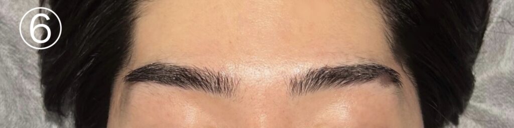 眉毛ニードル脱毛(針脱毛)6回目