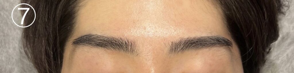 眉毛ニードル脱毛(針脱毛)7回目