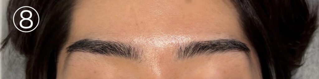 眉毛ニードル脱毛(針脱毛)8回目