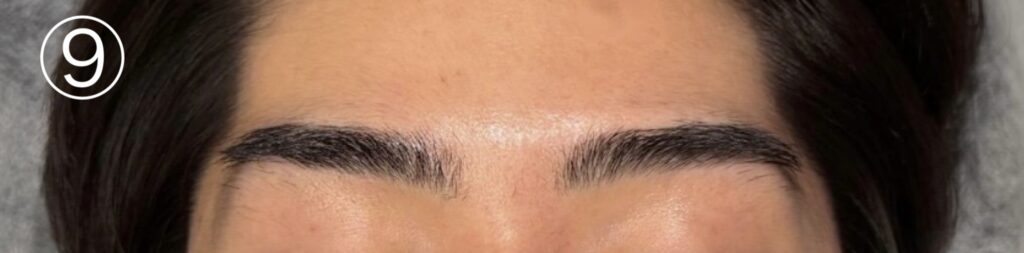眉毛ニードル脱毛(針脱毛)9回目