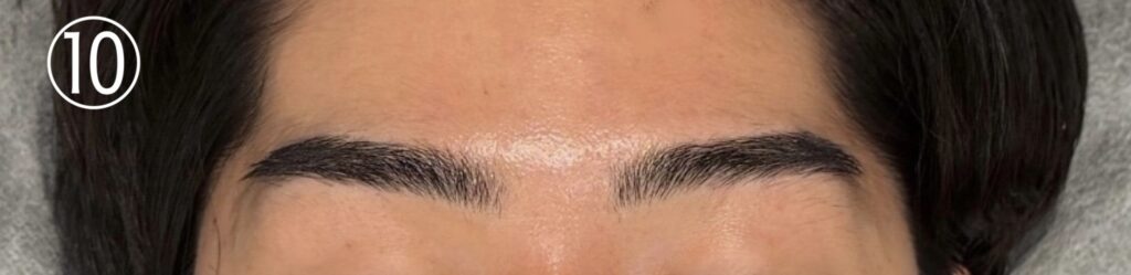 眉毛ニードル脱毛(針脱毛)10回目